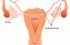 Endometriosis is a medical condition in women in which endometrial cells are deposited in areas outside the uterine cavity