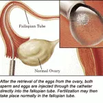 The value of IVF–ET in patients undergoing treatment by the GIFT procedure