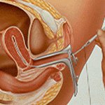 Intra-Uterine Insemination (also known as artificial insemination) – IUI