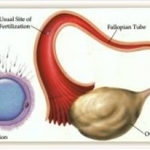 Tubal Infertility