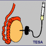 Testicular Sperm Aspiration – TESA